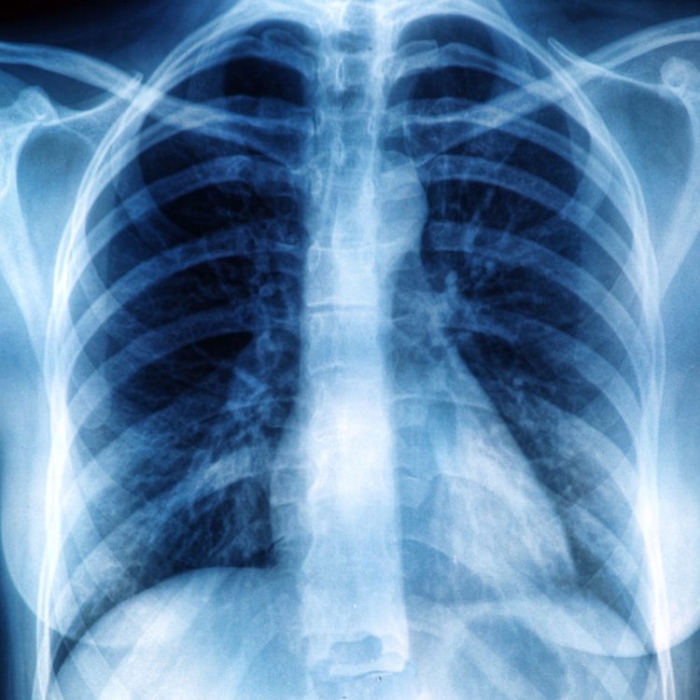 Mit jelent a röntgen átvilágítás?