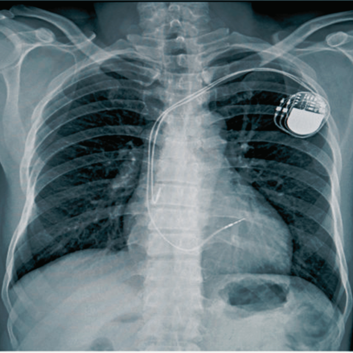 Mit jelent a pacemaker/ICD kontrol