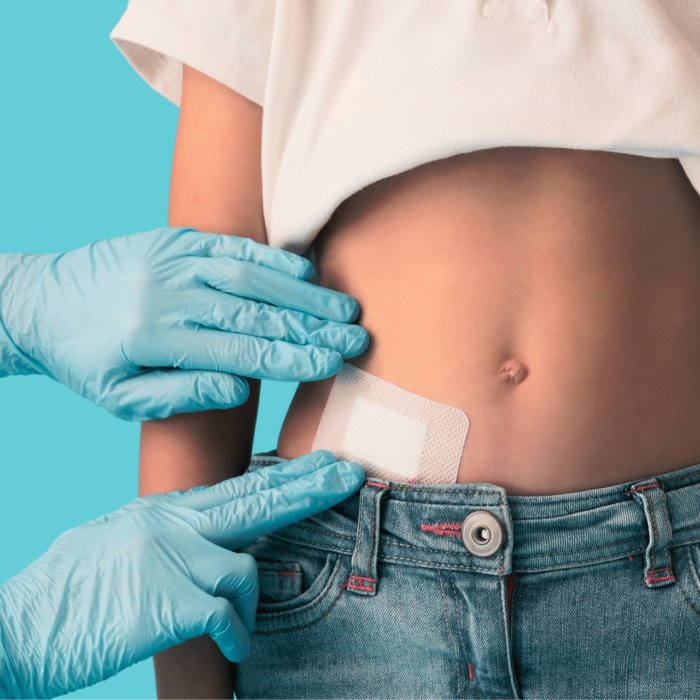 Mi a robotasszisztált sérvműtét? 