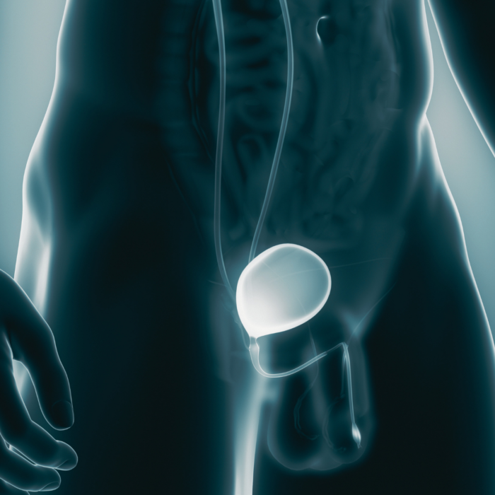 Miért kell eltávolítani az ureter- és veseköveket? 